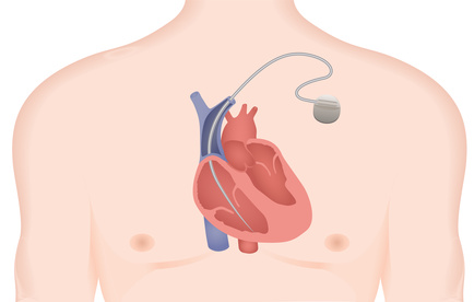 Ein Herzschrittmacher ist so klein, dass er unter die Haut implantiert werden kann